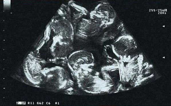 бебета-ултразвук